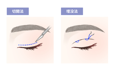 埋没法・切開法（上まぶた）