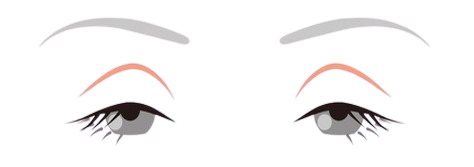 眼瞼下垂：眼瞼下垂手術