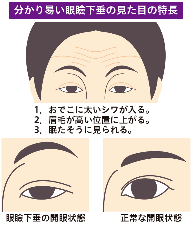 眼瞼下垂の症状セルフチェック
