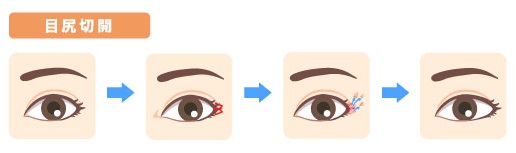 外眥短縮術（目尻切開）