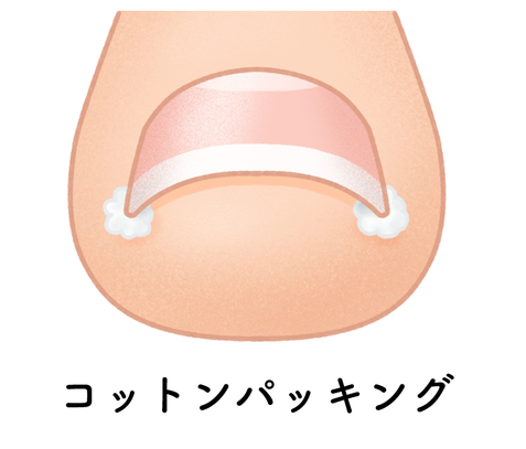コットン挿入