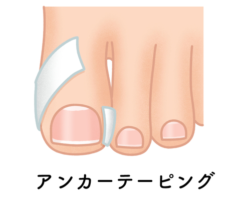 テーピング