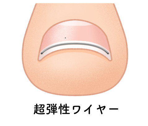 ワイヤー矯正