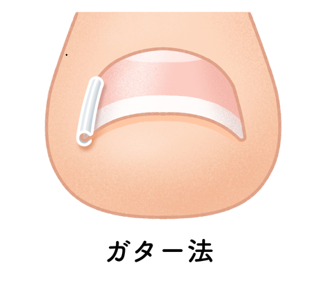 ガター法