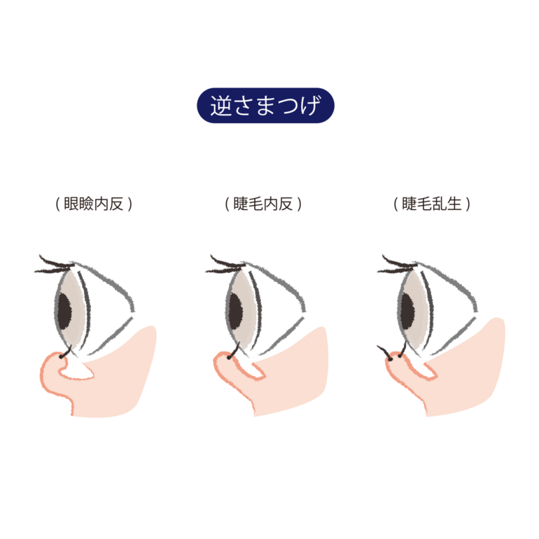 逆まつ毛の種類