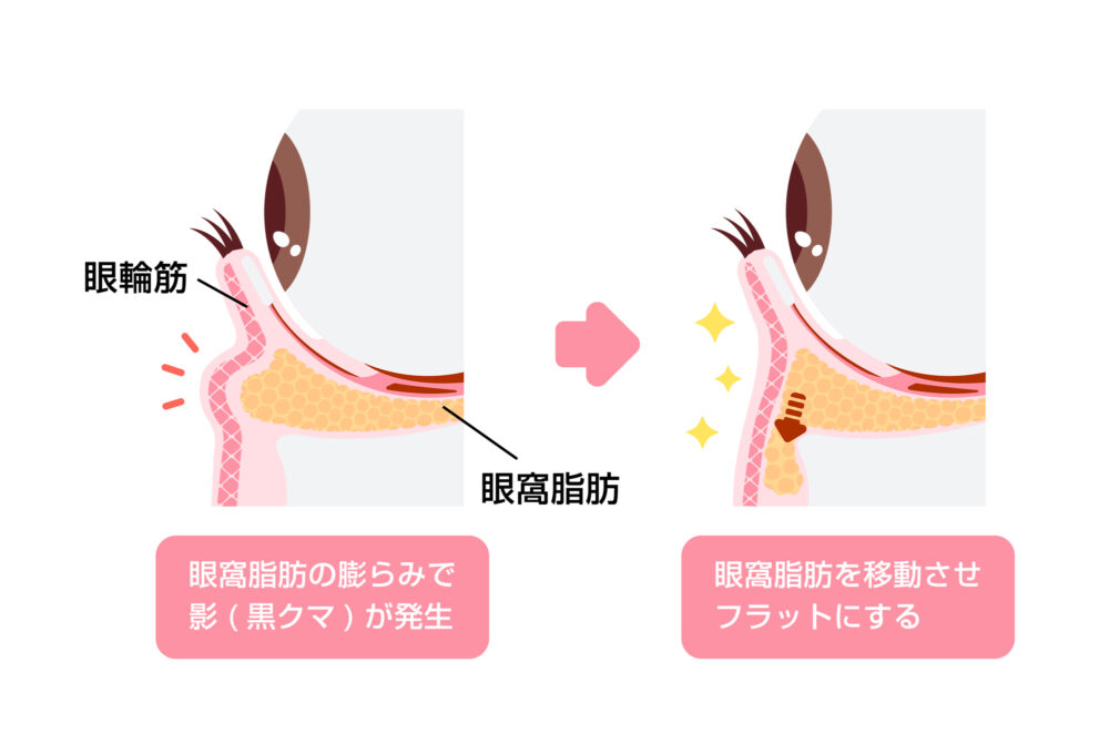 裏ハムラ法（経結膜的脂肪再配置）