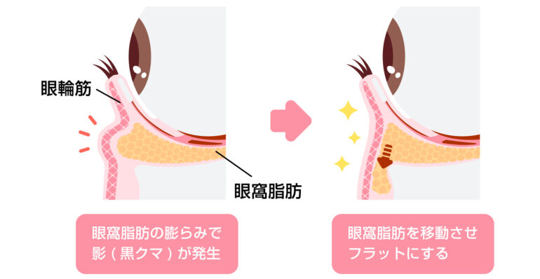裏ハムラ法（経結膜的脂肪再配置）