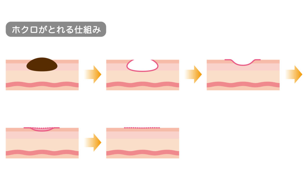 ほくろ除去の方法