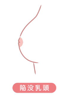 陥没乳頭の原因