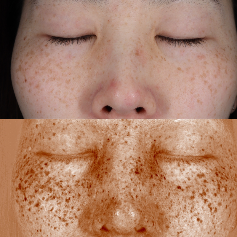 ルビーフラクショナル術前