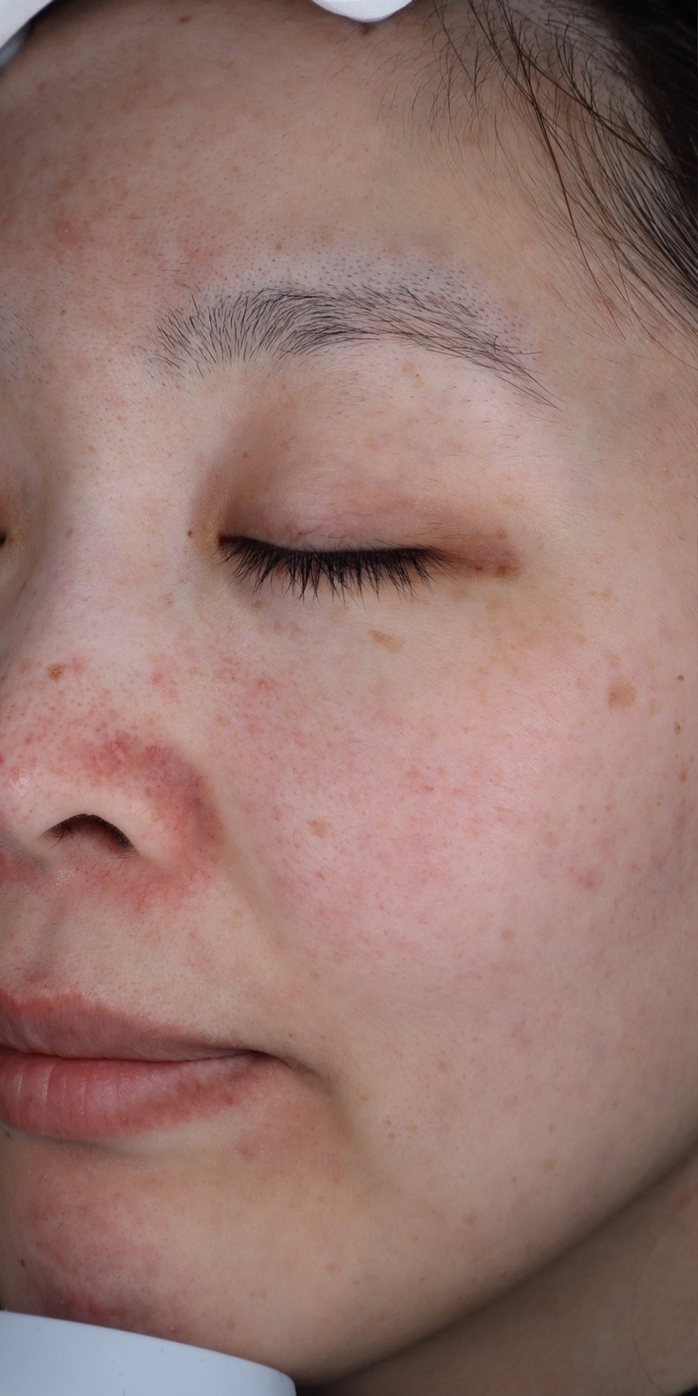 ルビーフラクショナル術前