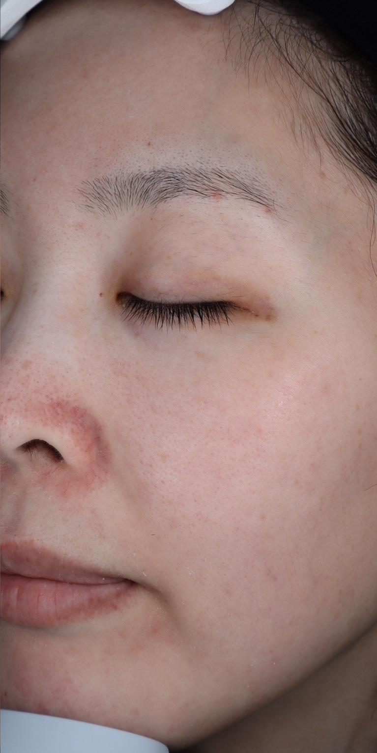 ルビーフラクショナル術後