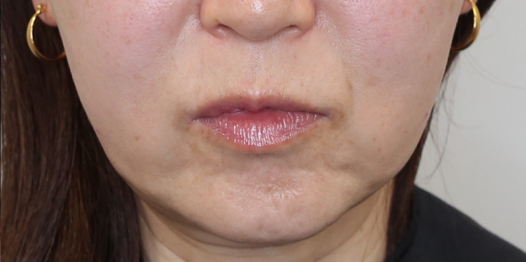 ボルニューマー術前