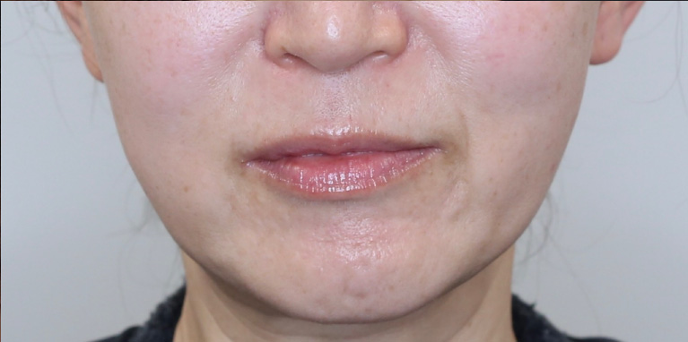 ボルニューマー術後